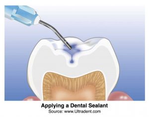 Applying Dental Sealant