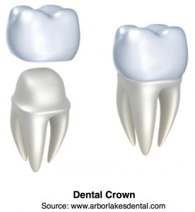 Dental Crown