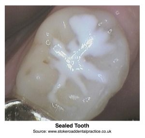 Sealed Tooth