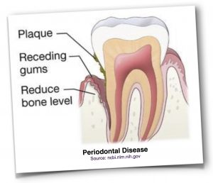 periodontal disease