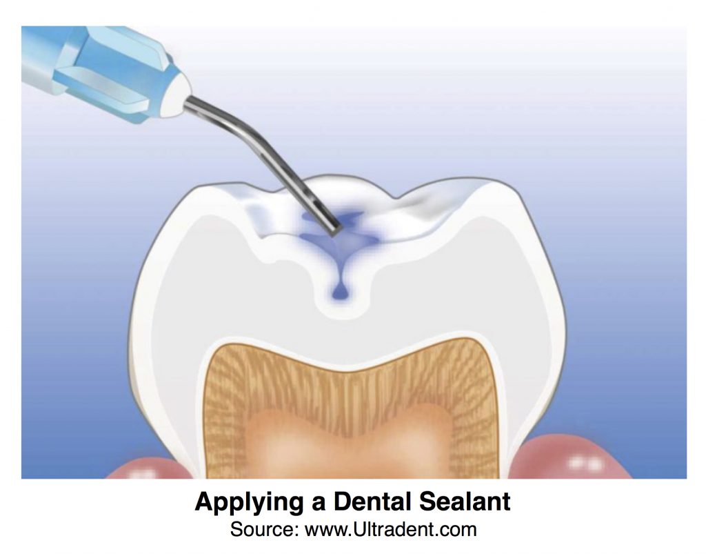 Dental Sealants Procedure - Growing Beautiful Smiles